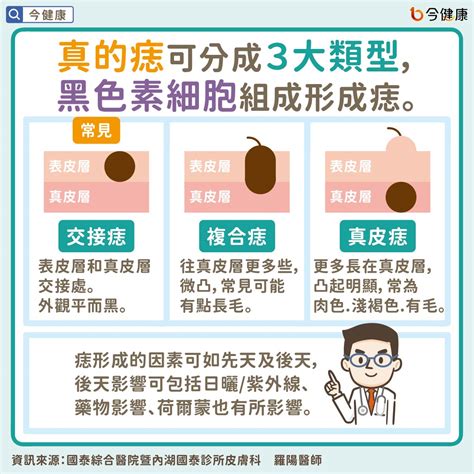 會長大的痣|痣是什麼？一次了解痣原因、就醫時機以及如何改善